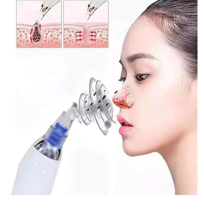 Portable Blackhead Remover